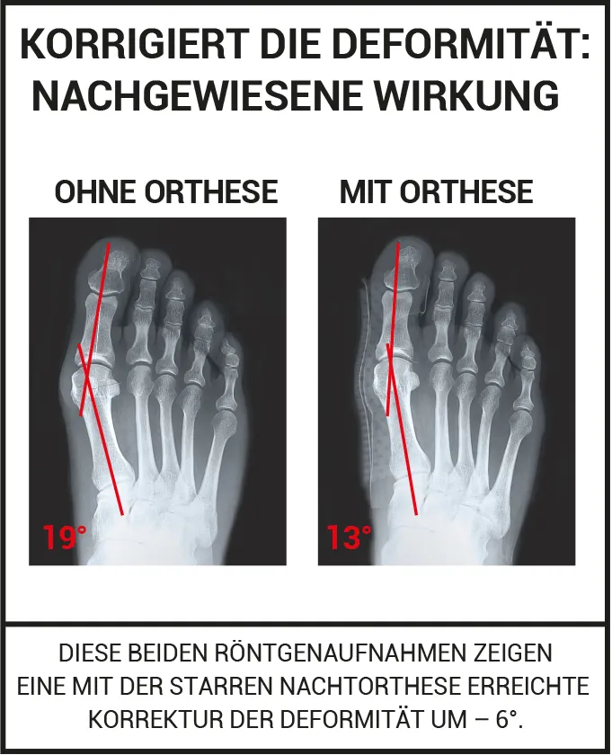 Korrigiert die deformit